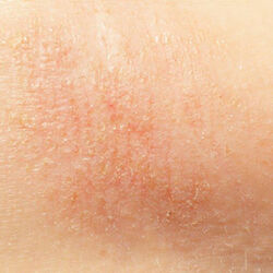 Example of eczema